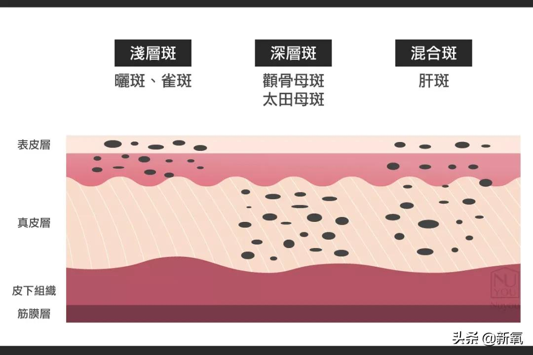 奶酷少年脸成高奢新宠模特？多亏了她满脸的雀斑…