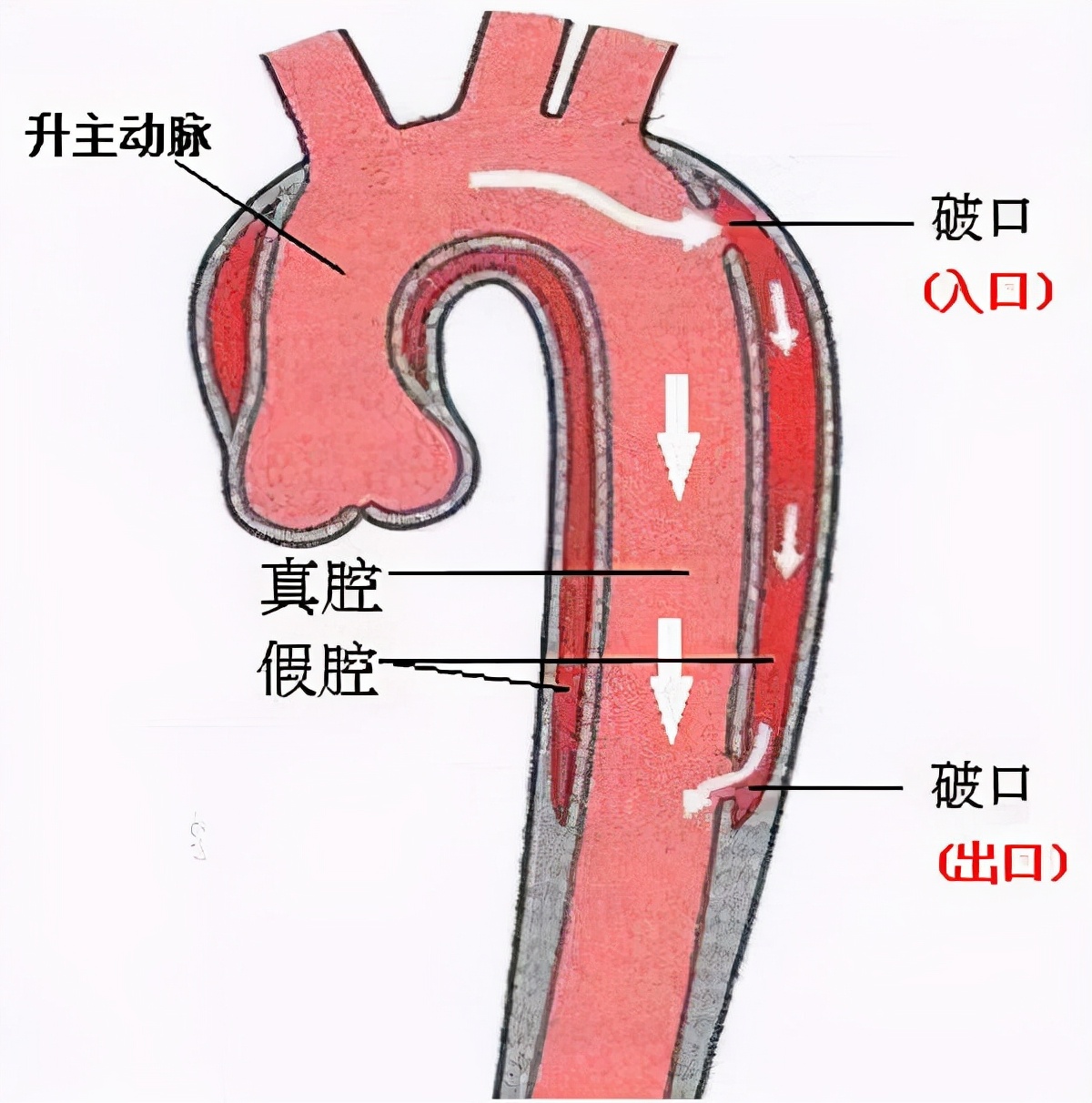 胸疼难忍，以为心梗，医生说比心肌梗死重10倍！基本无力回天