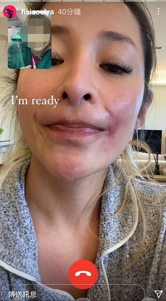 萧亚轩宣告正式复出，脸上被爱犬咬伤的伤疤清晰可见