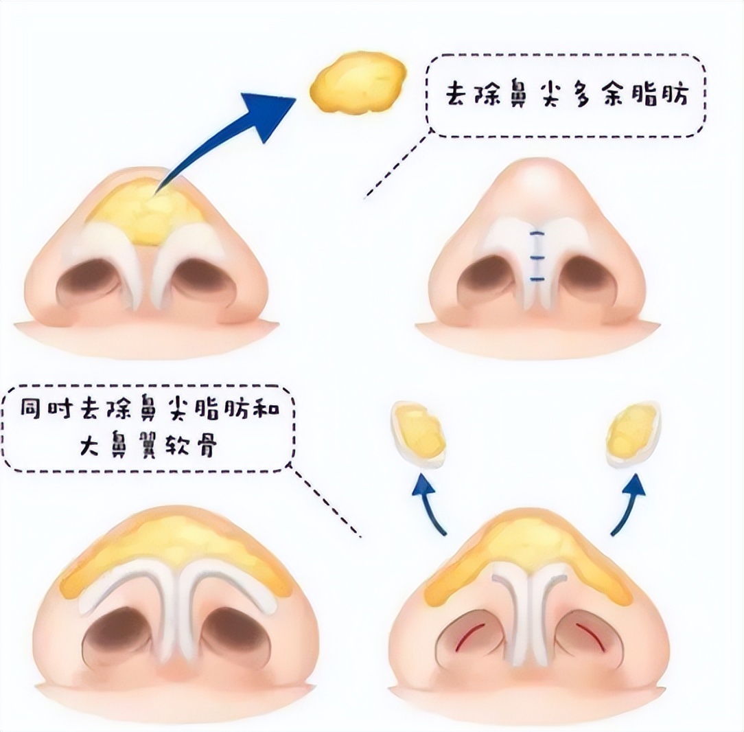 大鼻头能缩小吗，有哪些有效的方法？