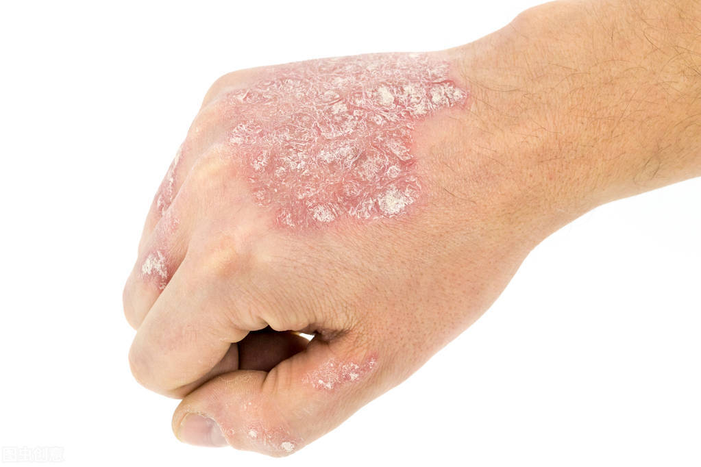 皮肤病不挠也痒，越挠越痒怎么办？中医常用6个止痒方法