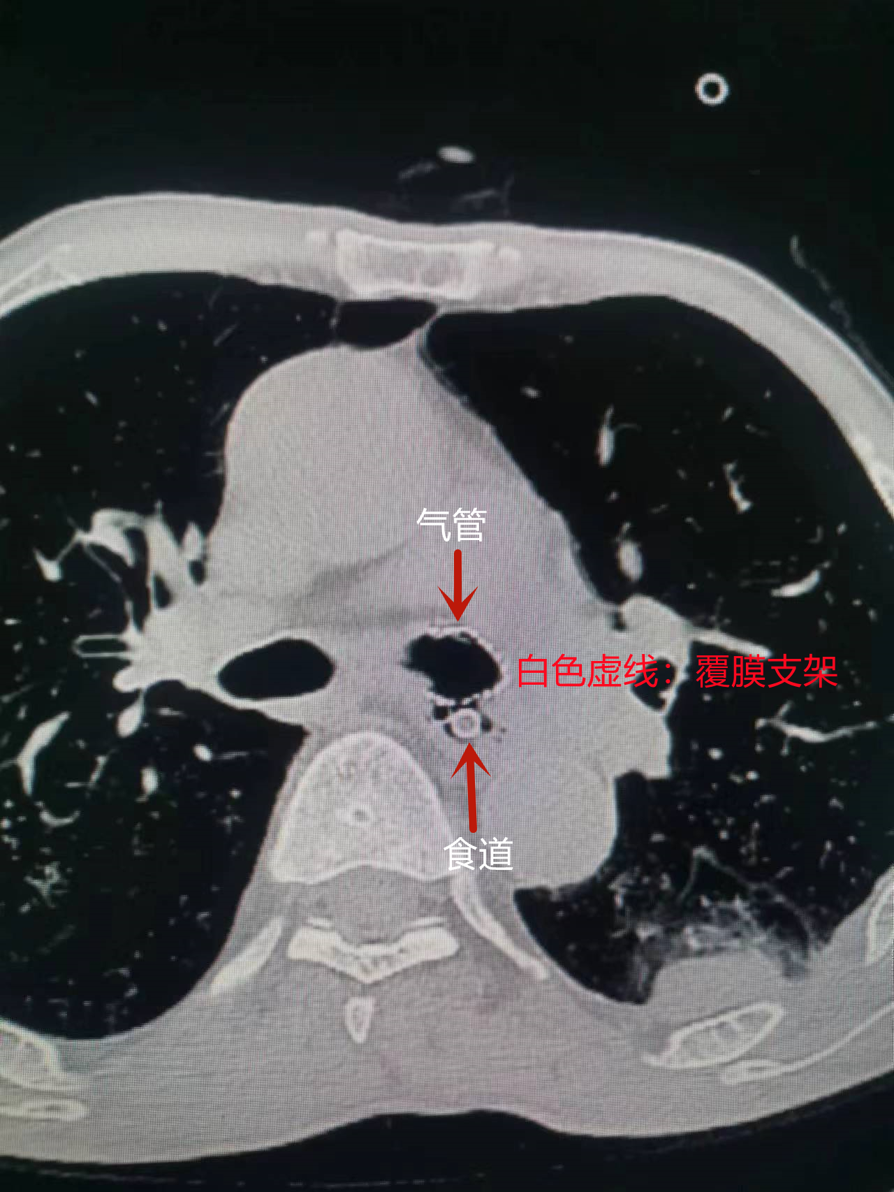 “查瘘补缺”！郫都区人民医院成功完成区内首例呼吸介入四级手术