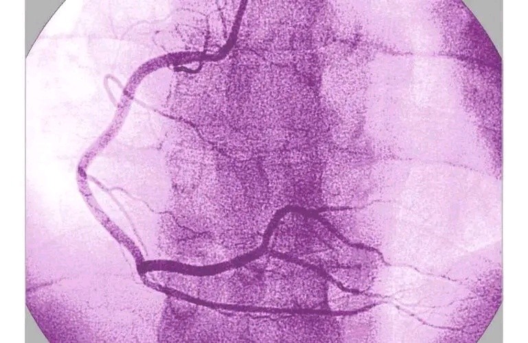 做完冠脉造影，对健康伤害很大？冠脉造影检查对人体有哪些危害？