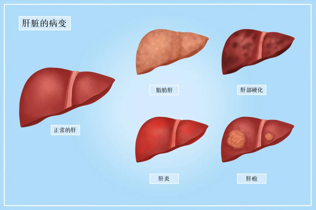 哪些人容易感染乙肝？6类高危人群要注意