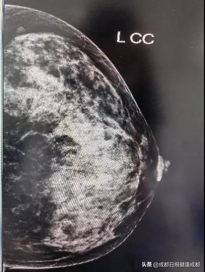 吓趴了！乳房胀痛甚至有硬物是不是得了乳腺癌？
