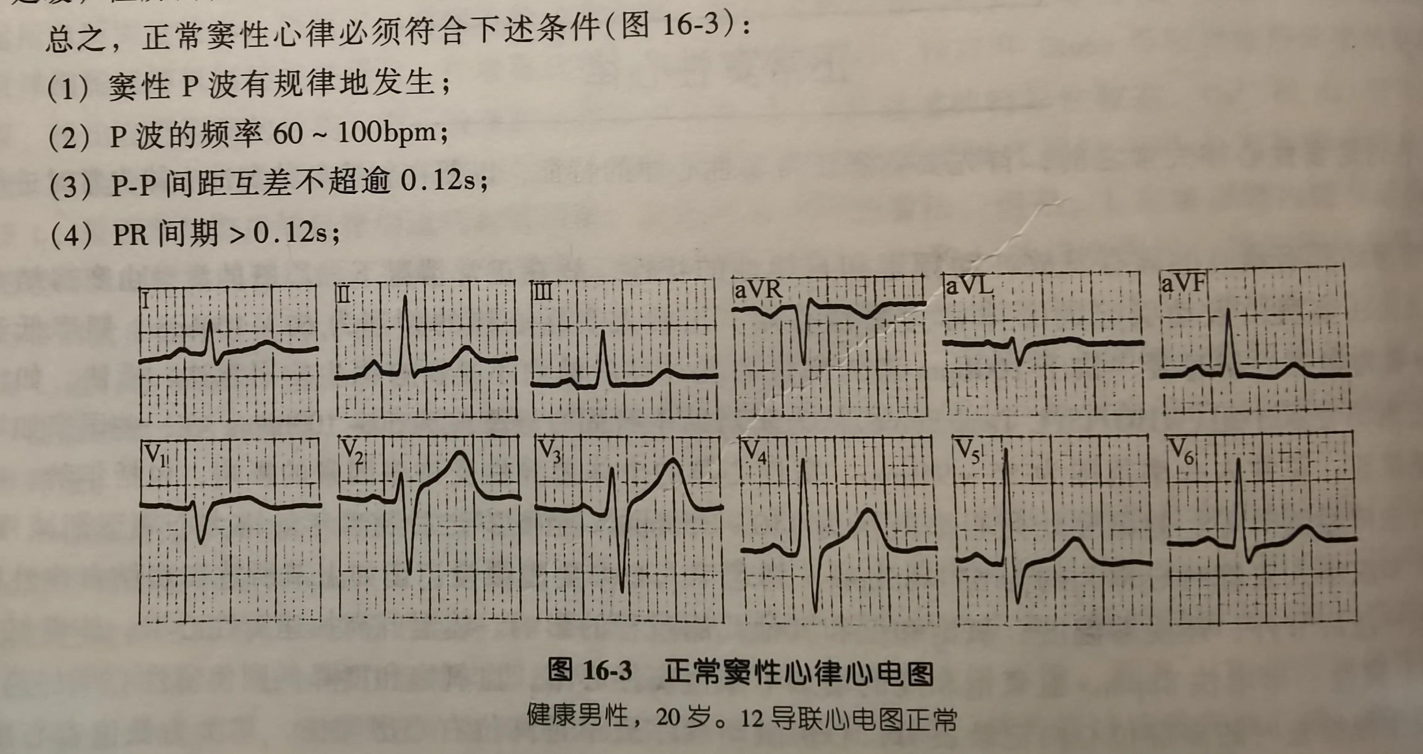 窦性心律是(心电图上写着窦性心律)