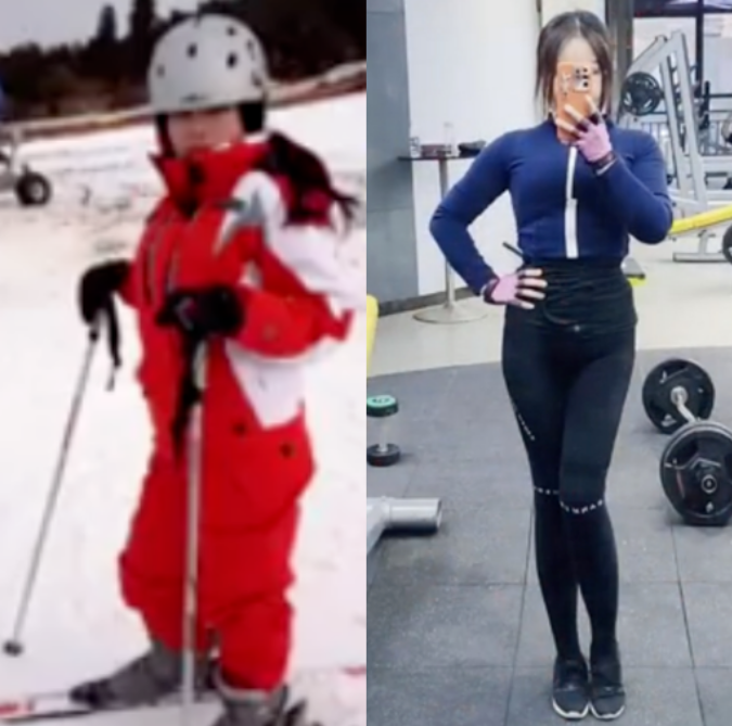 7年前花费了家里16万，只为增高7.2厘米的男孩，如今与后遗症为伴