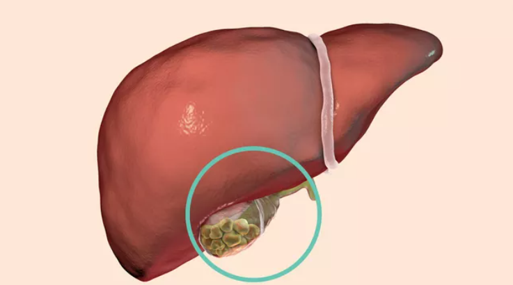 膽結石是在膽囊中形成的結石,膽囊是一個懸掛在肝臟下方的小囊,根據