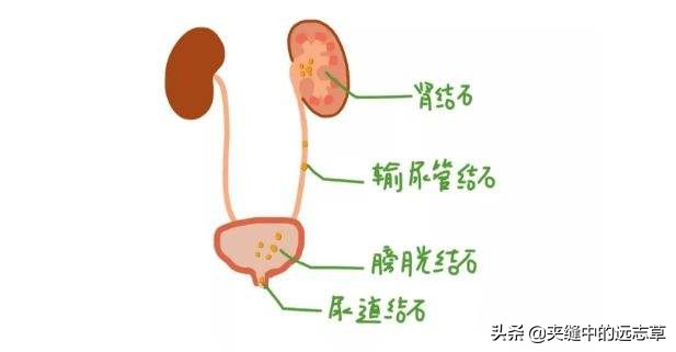 结石？送你十一味中药，清湿热、化积石，湿热即除，何愁积石？