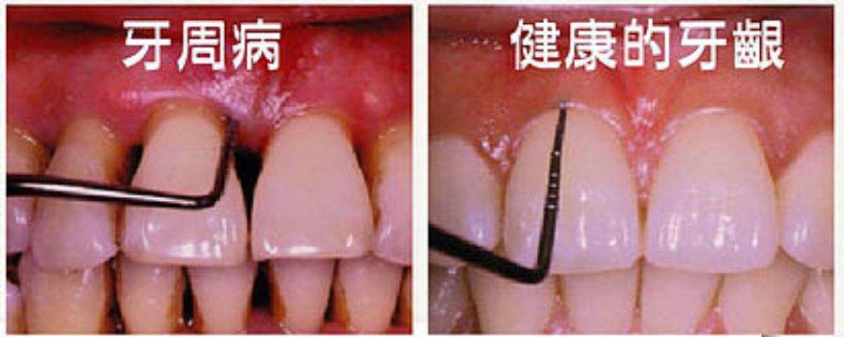 牙根外露怎么解决?老专家告诉你最正确的做法