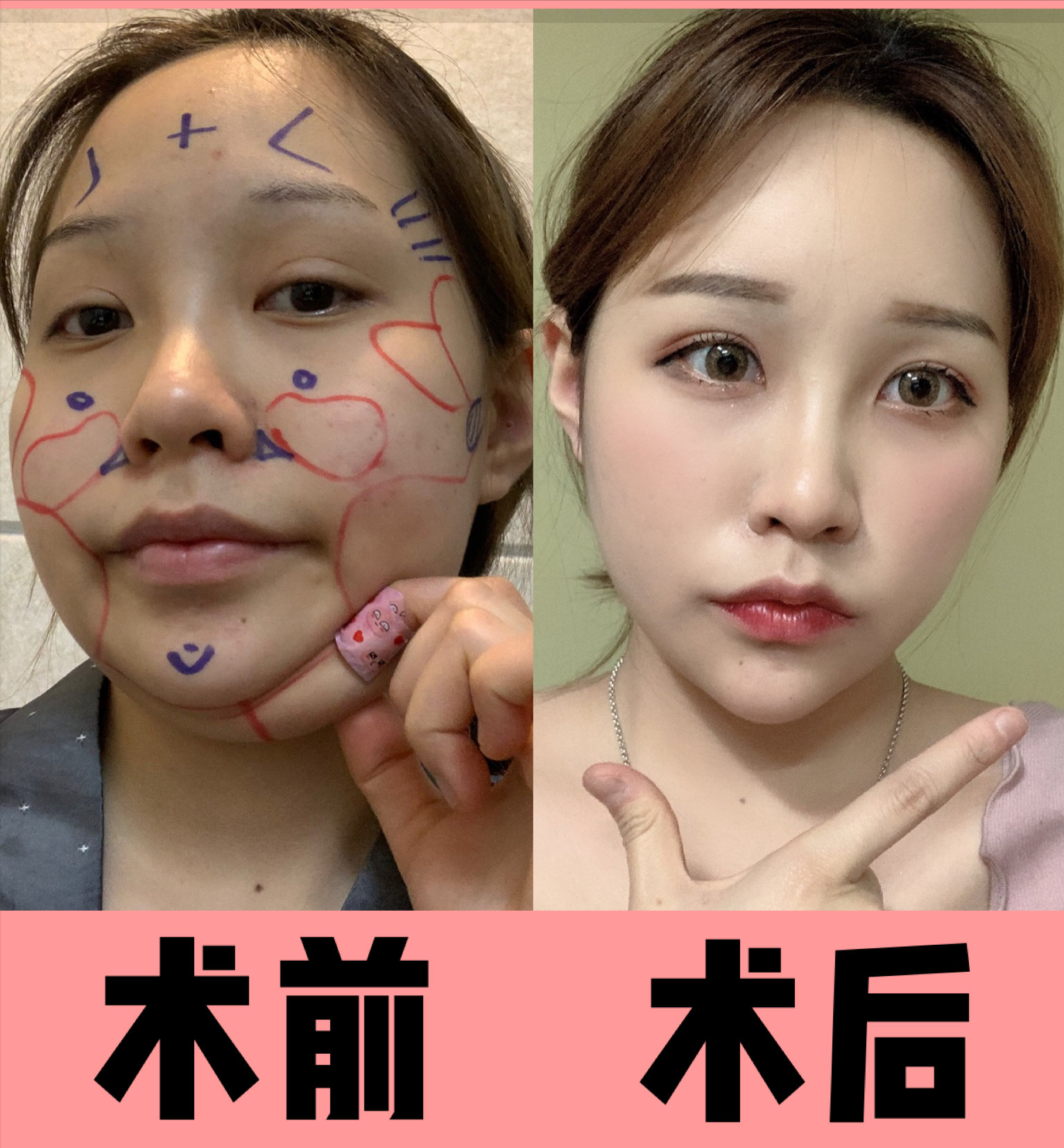 34岁小姐姐做了面部吸脂后,闺蜜以为我换了一张脸