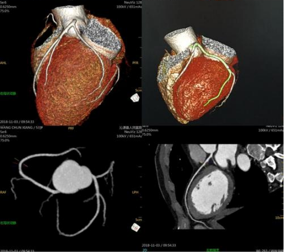 冠心病检查不只有造影，更便宜、有效地检查门诊就能做，值得收藏