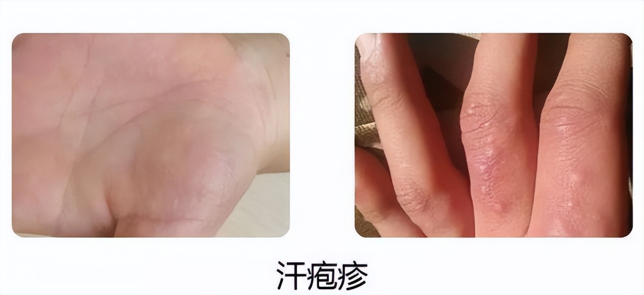 01,为什么会出现汗疱疹呢?