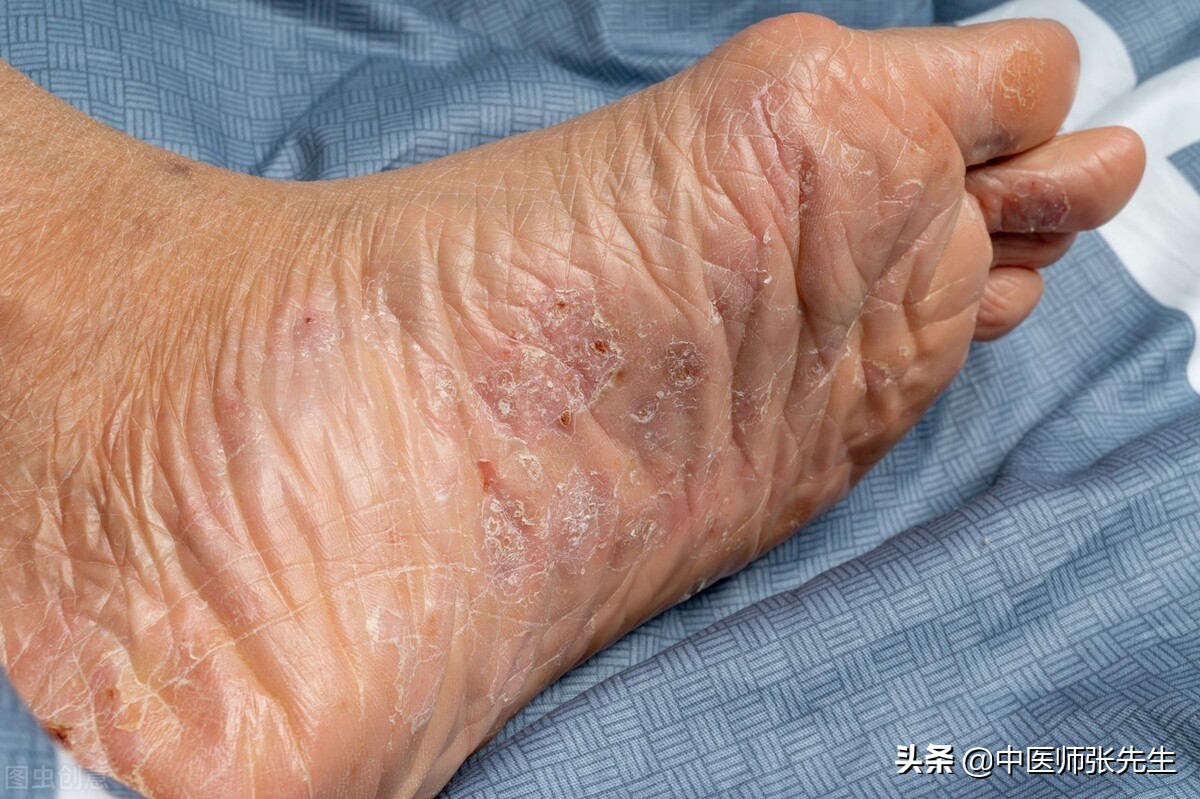顽固性脚气老不好,这到底是怎么回事?