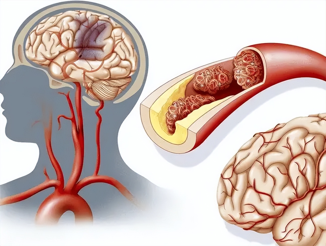 提醒:不论男女,睡觉时有3"异常",脑血管早已"堵得慌"