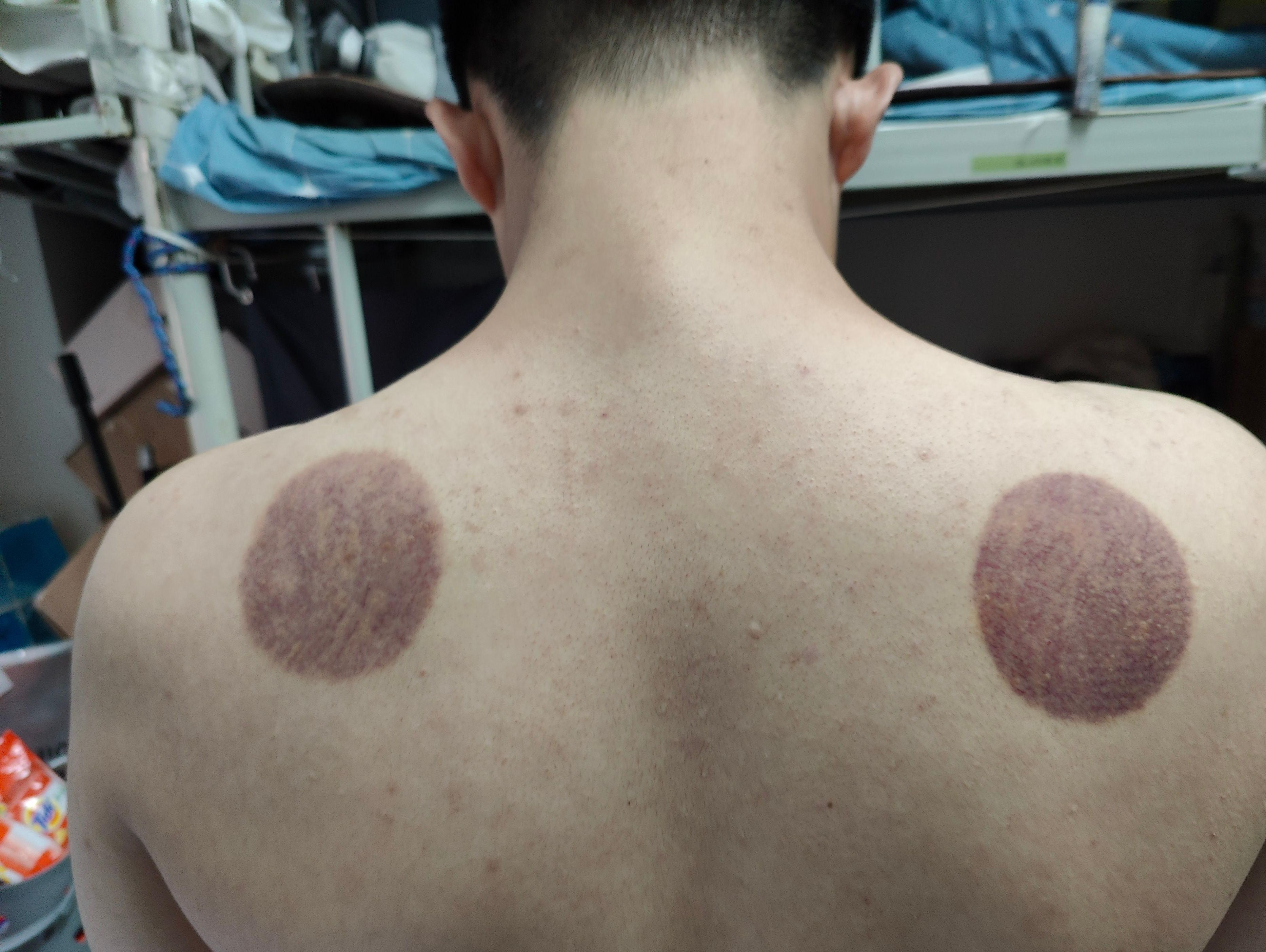 左点智能走罐按摩器，秒出痧，去湿气，养生小帮手