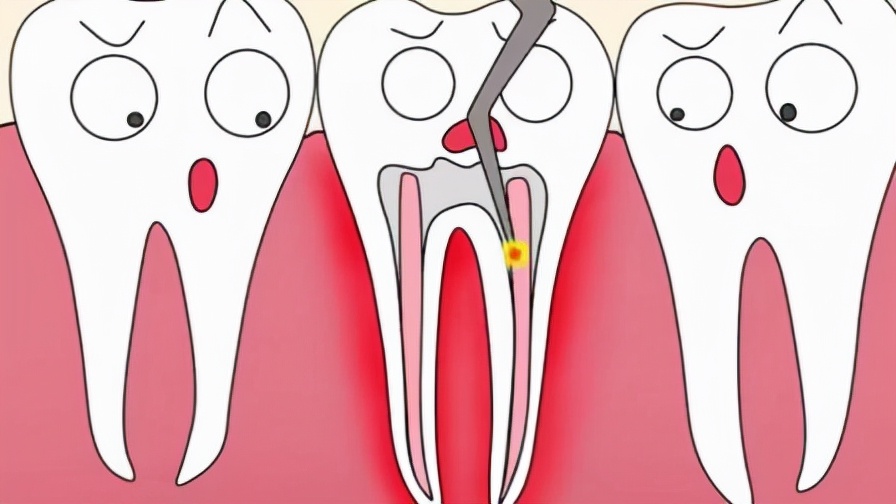 「牙齿那些事儿」No.79丨什么是根管治疗？根管后的牙齿能用多久