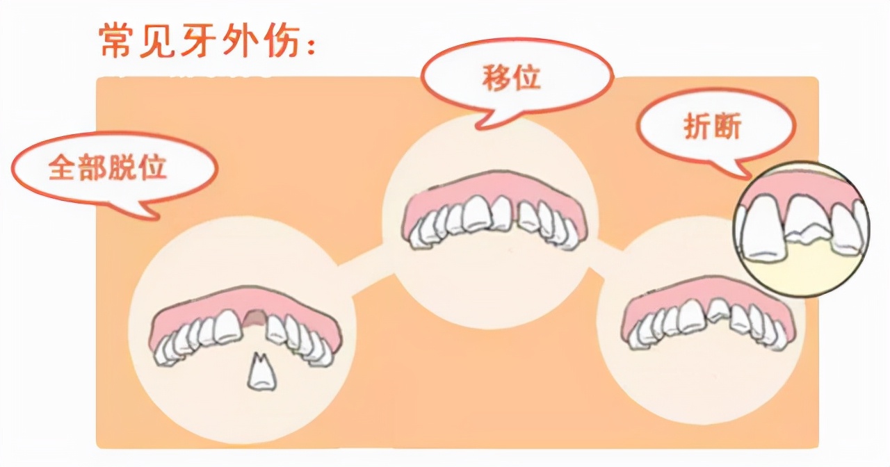 孩子牙龈鼓包,除了萌出囊肿,你还需要知道什么?