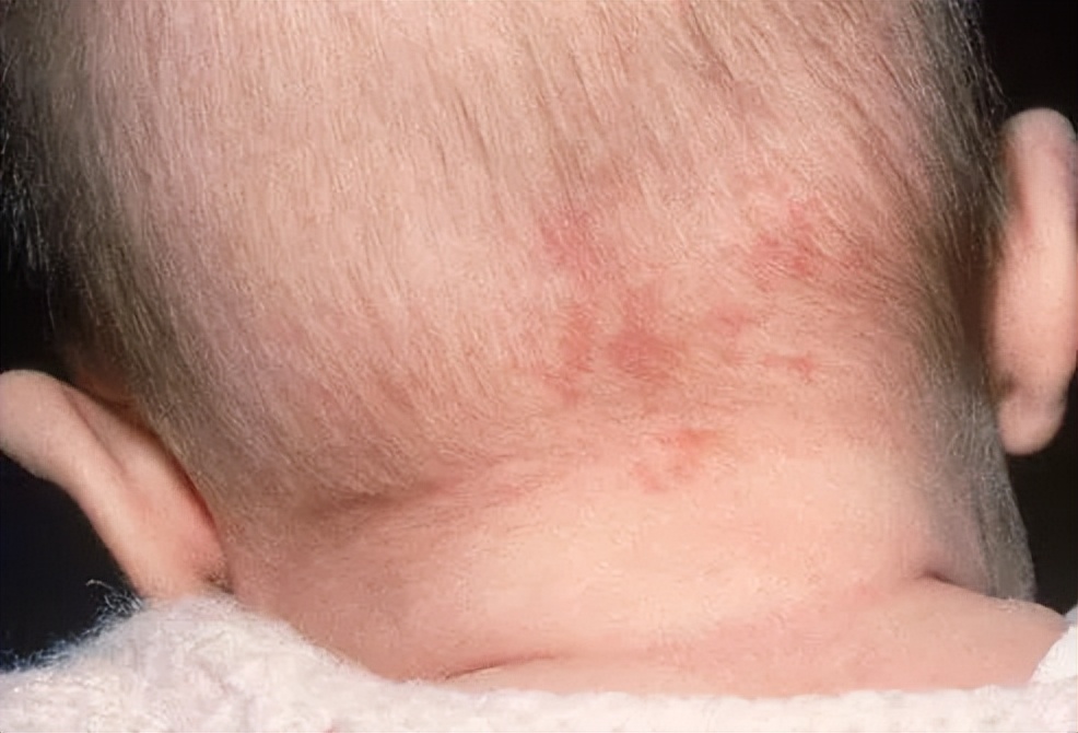 婴儿头皮上有红斑图片图片