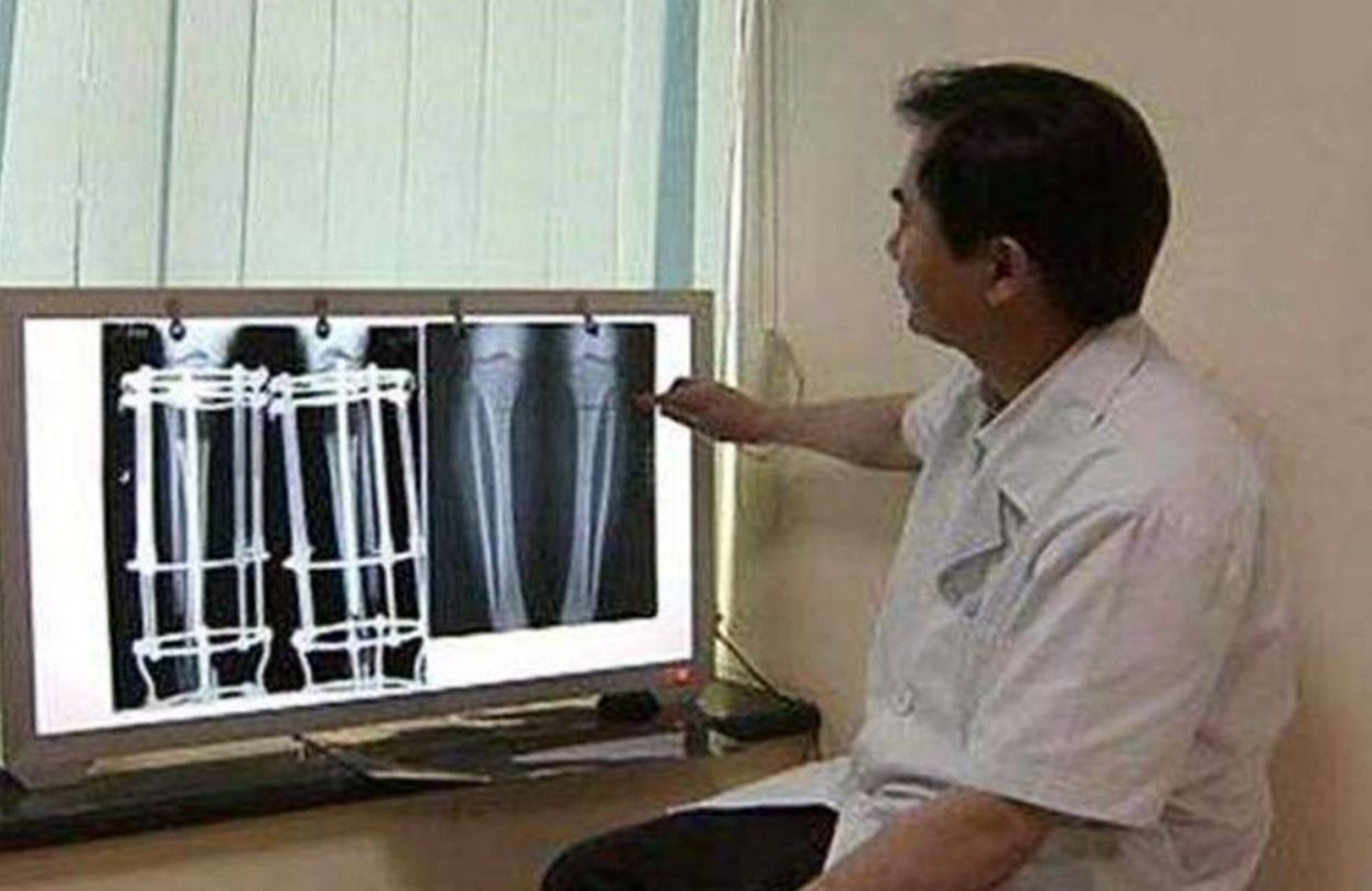 7年前，为长高7厘米花16万做断骨手术的李亚诺，余生与后遗症相伴