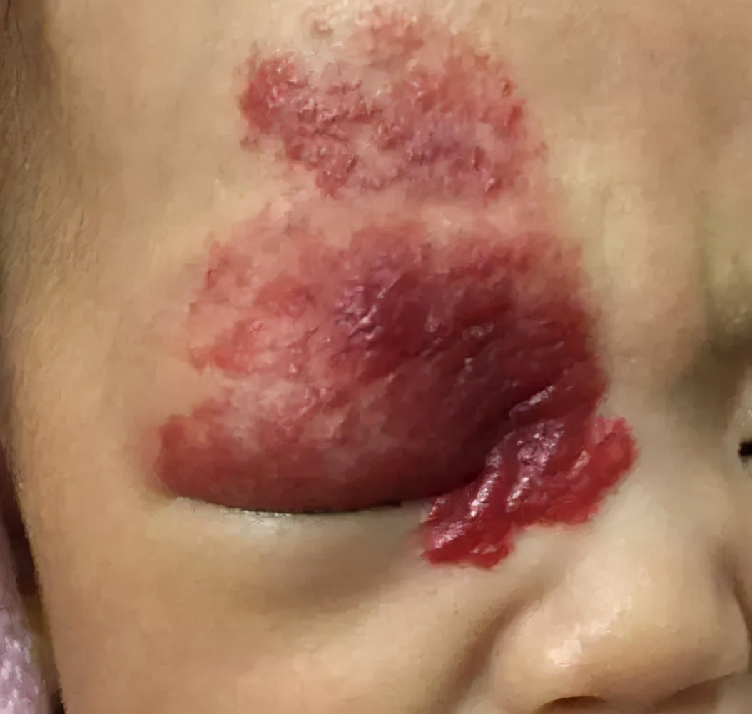 孩子脸上结出"草莓",医生说是血管瘤,对孩子危害大吗?