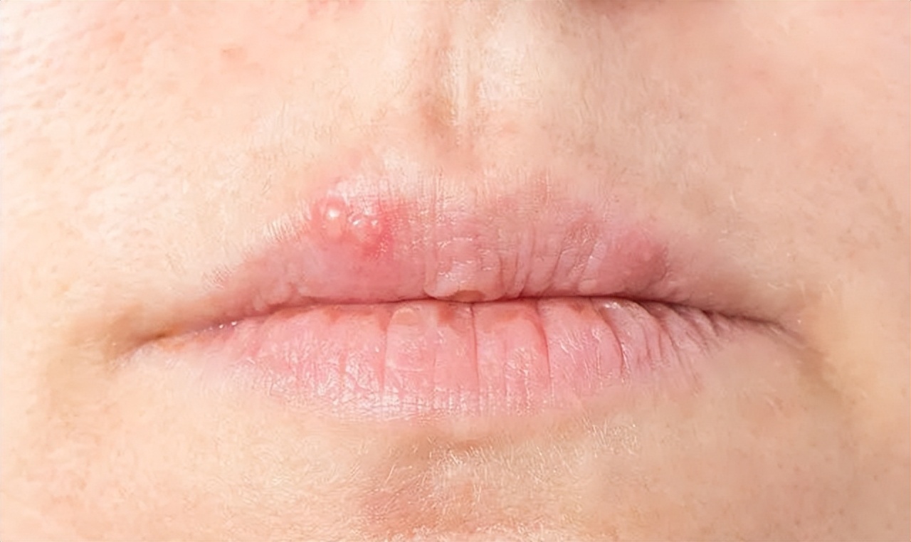 嘴巴周围时不时出现"几个水泡",或许不是"上火",应注意