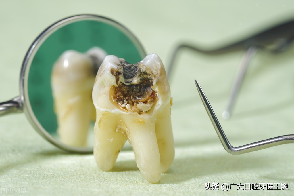 这些残根危害可不小,严重要截骨