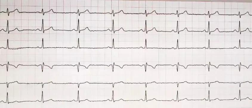 心律不齐什么鬼？教你轻松读懂心电图