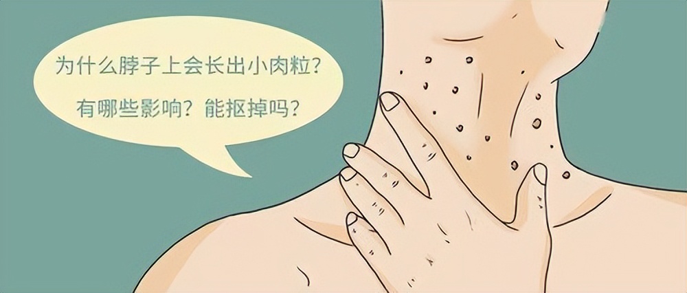 脖子和腋下的“小肉粒”是什？ 能不能用手掉呢？ 早看早了解
