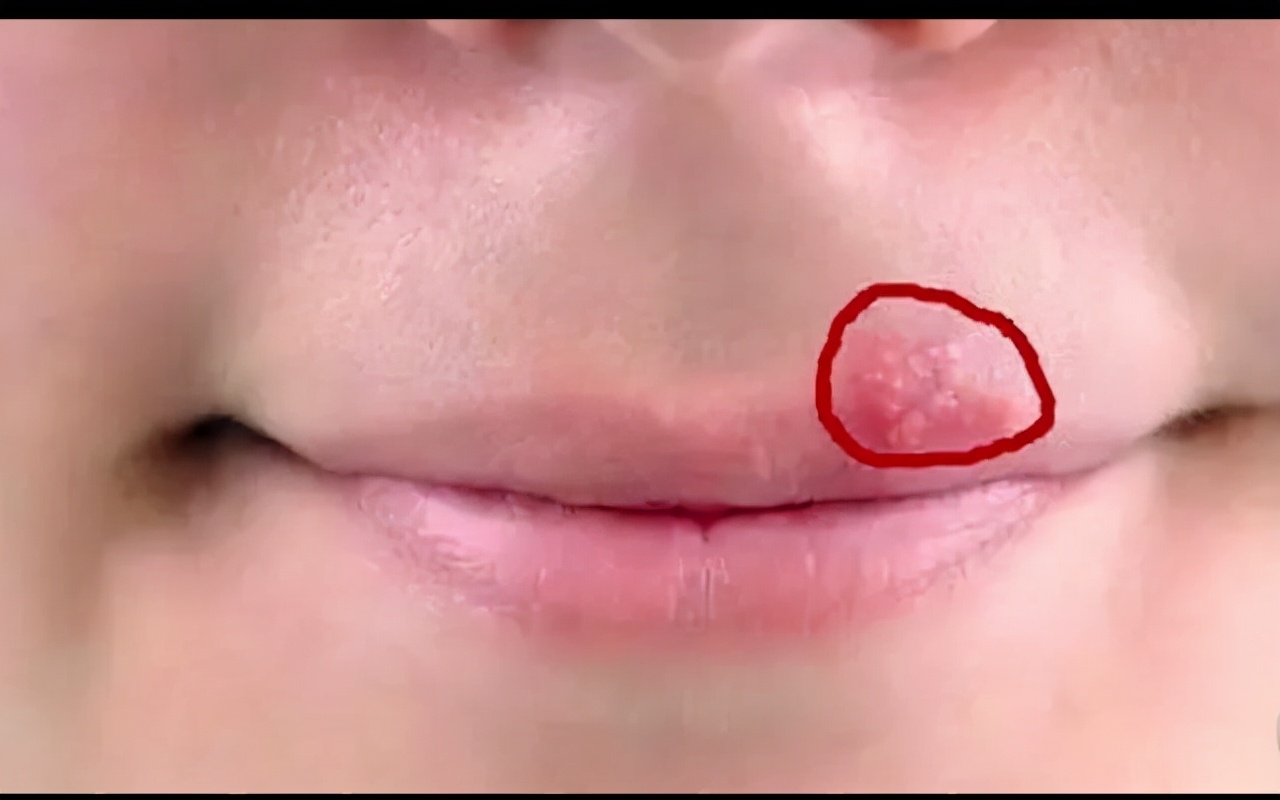 嘴巴周围时不时出现“几个水泡”，是什么原因呢？不妨来看一下