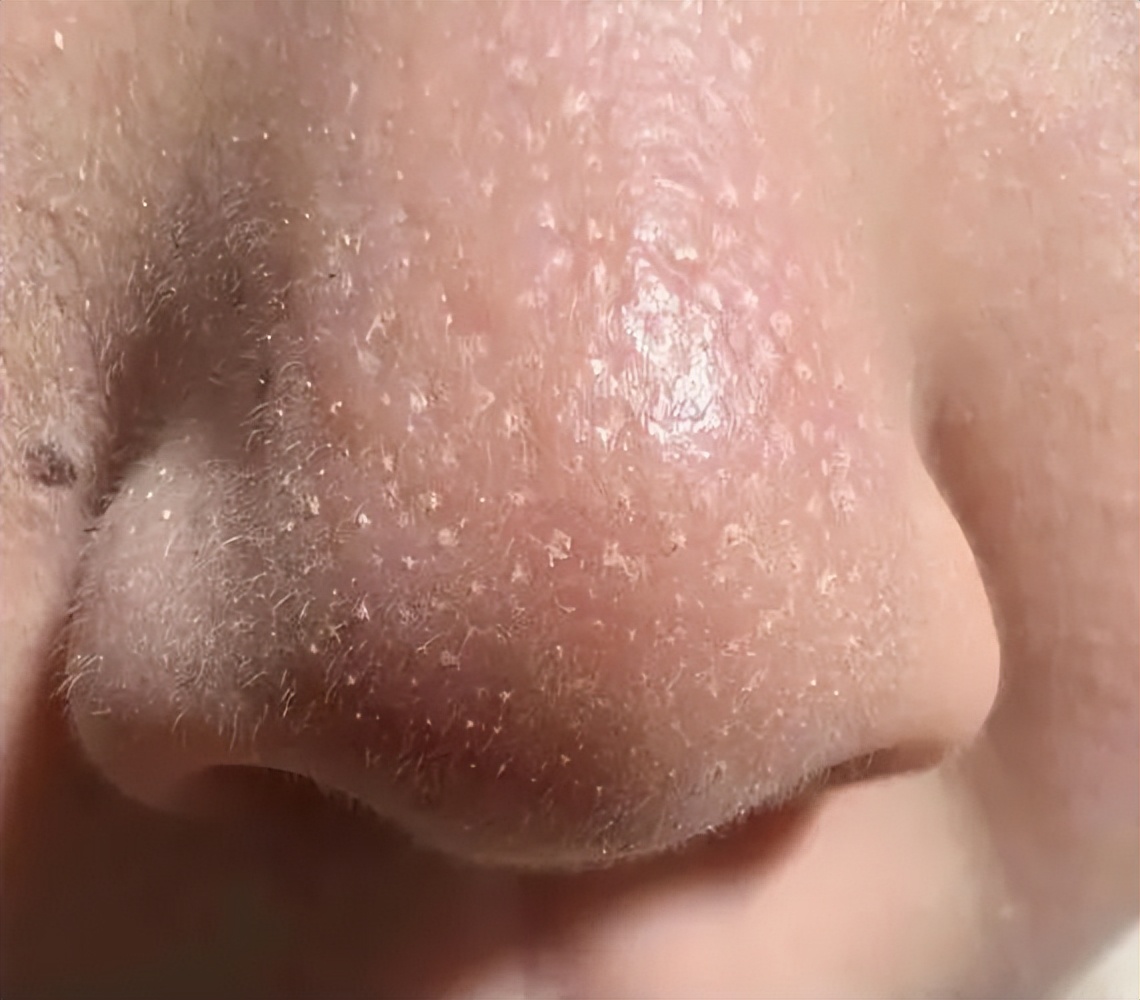 为什么上完粉底液以后，鼻子上有很多白点点？