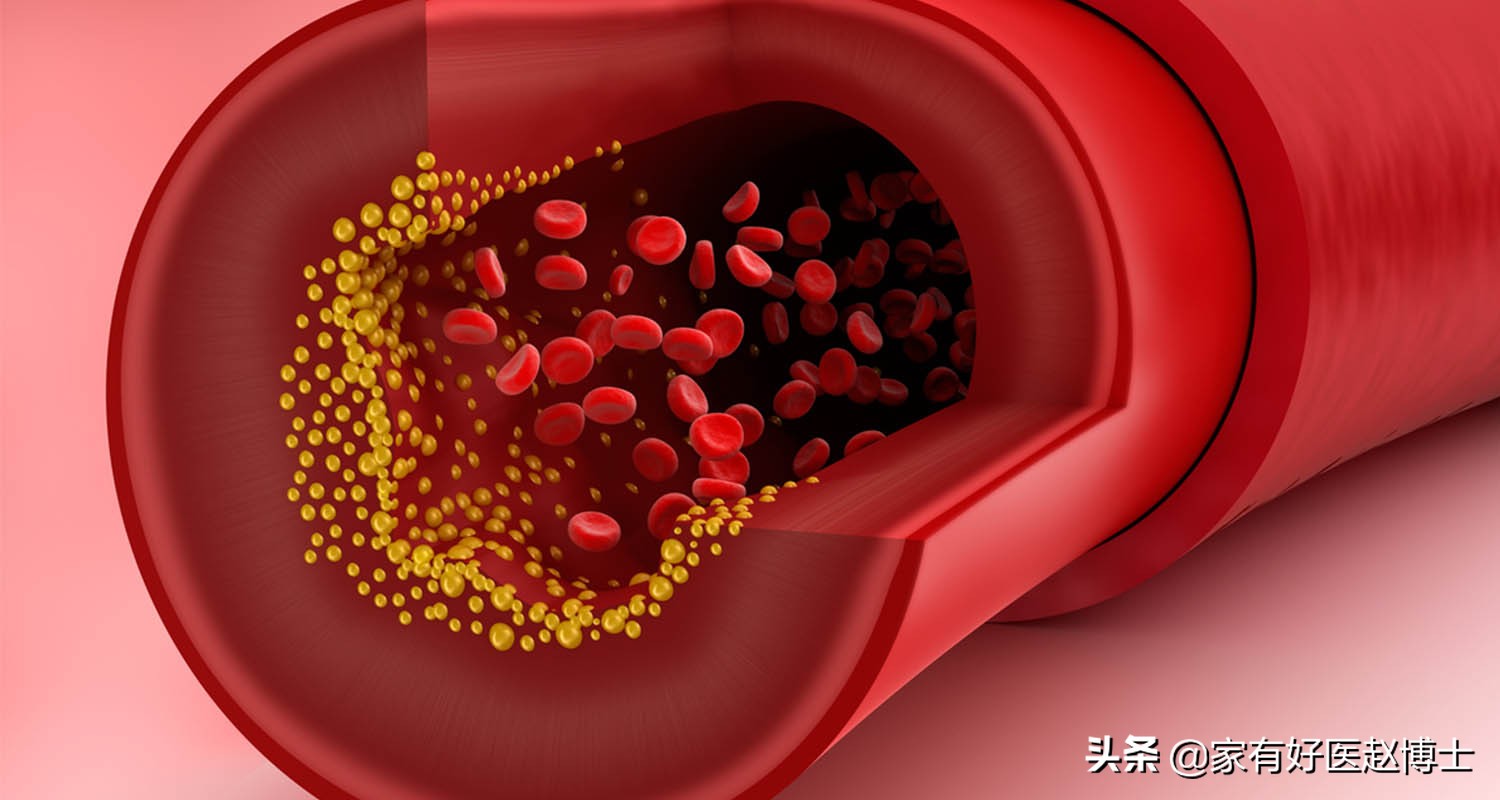 影响胆固醇高低，哪六项重要因素？如何通过它们改善胆固醇水平？