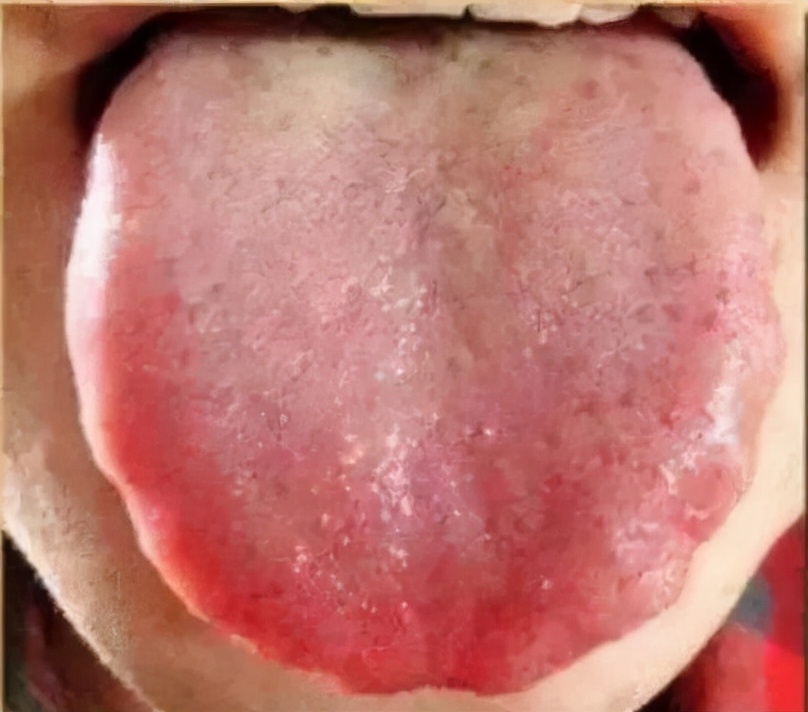 舌头边缘有齿痕，舌苔中间有裂纹？3种齿痕5种裂纹，你是哪一种？