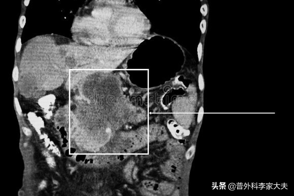 既然胰腺癌这么可怕，那能不能在高发年龄段就将它割掉？