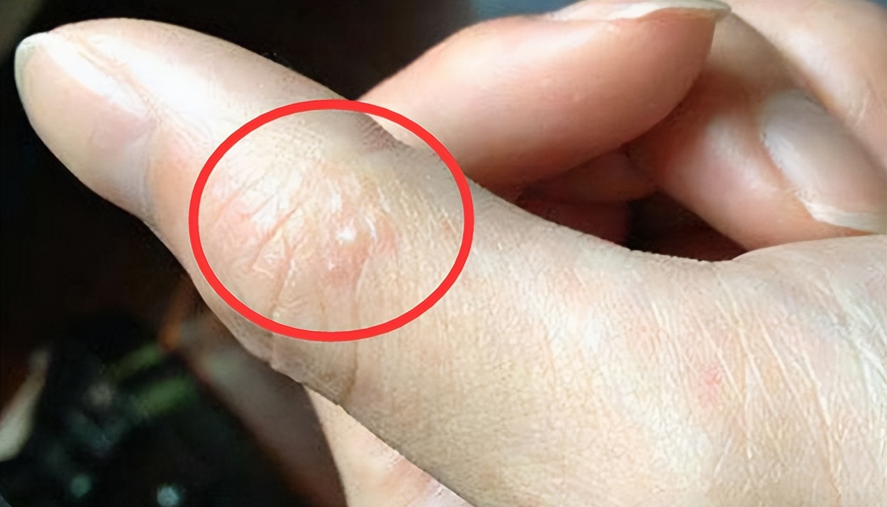 01,为什么会出现汗疱疹呢?