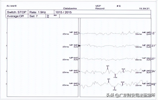 司法鉴定所对高坠伤致头面部损伤的法医临床鉴定