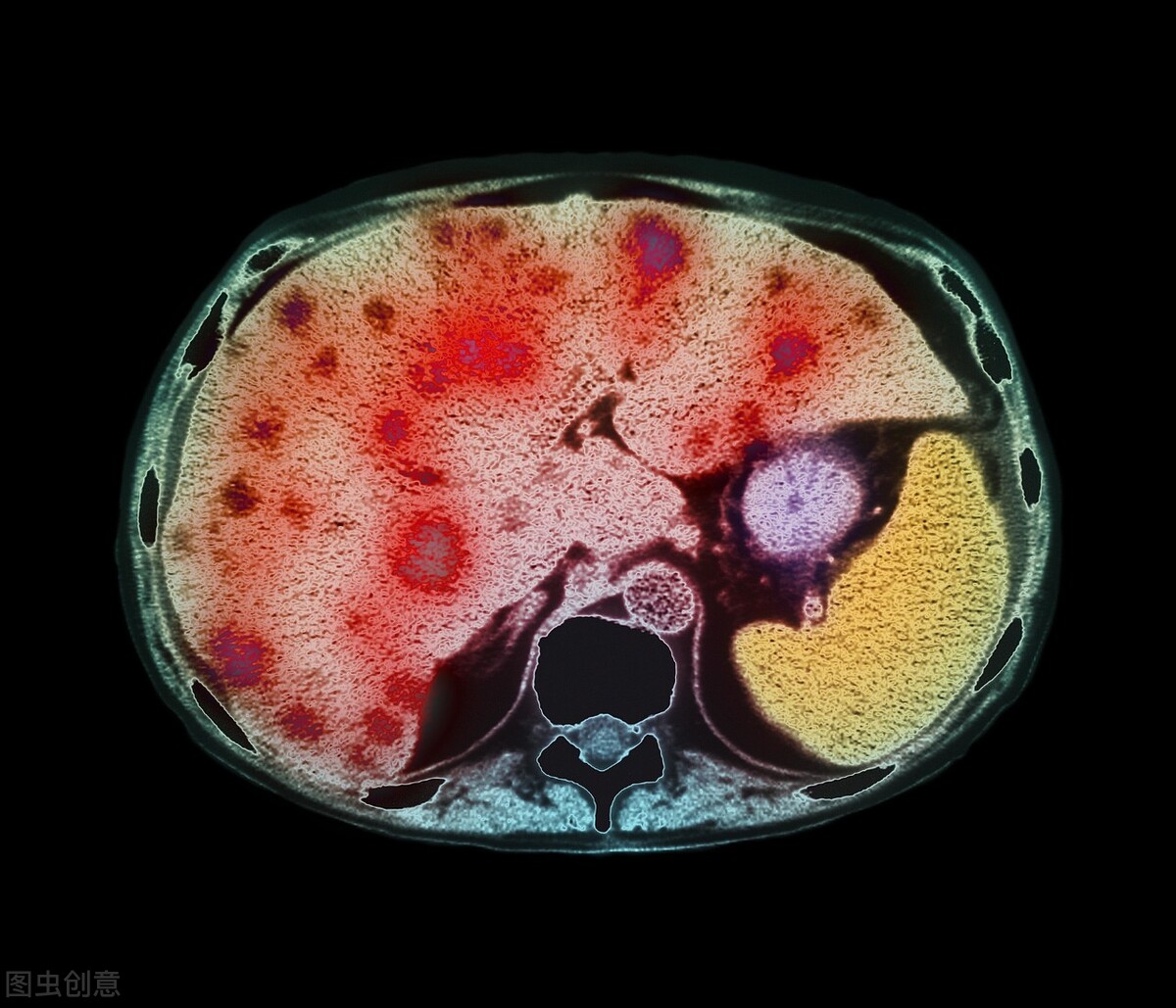 提到肝腹水,很多人想到的就是"肝癌晚期,还能活多久"……其实肝腹水