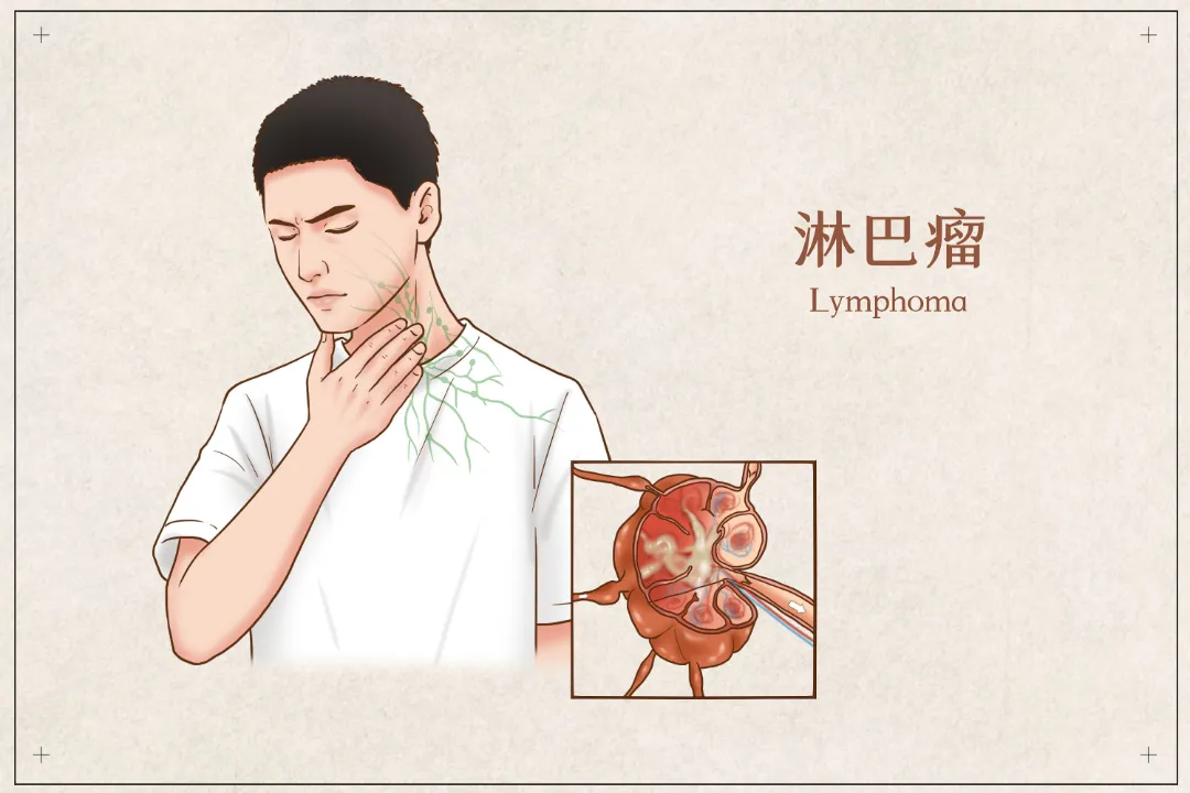 摸到淋巴结肿大怎么办?会是淋巴瘤吗?