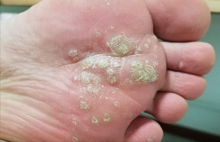 手足疣(跖疣)8分钟大解密!|孙叔公干货