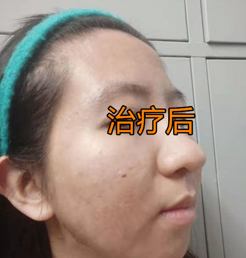 张女士激光治疗后，5年痘坑痘印彻底消失，现在感觉自信了很多