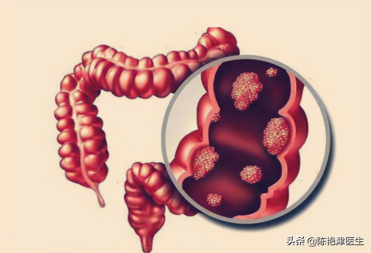 肠息肉形成原因及与肠癌关系