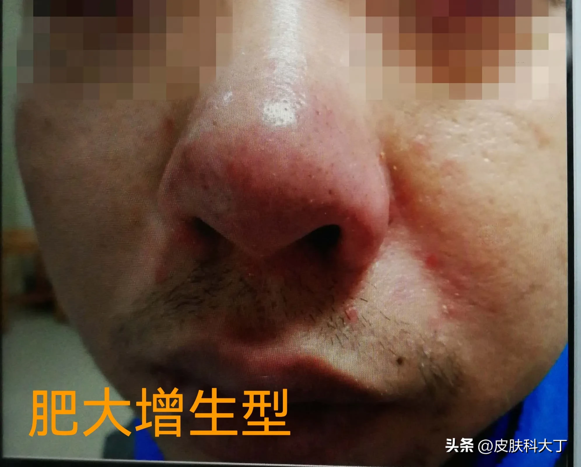 我的脸这几年反复发红，紧张或温度升高会更红,我妈妈和我外婆也有同样的症状