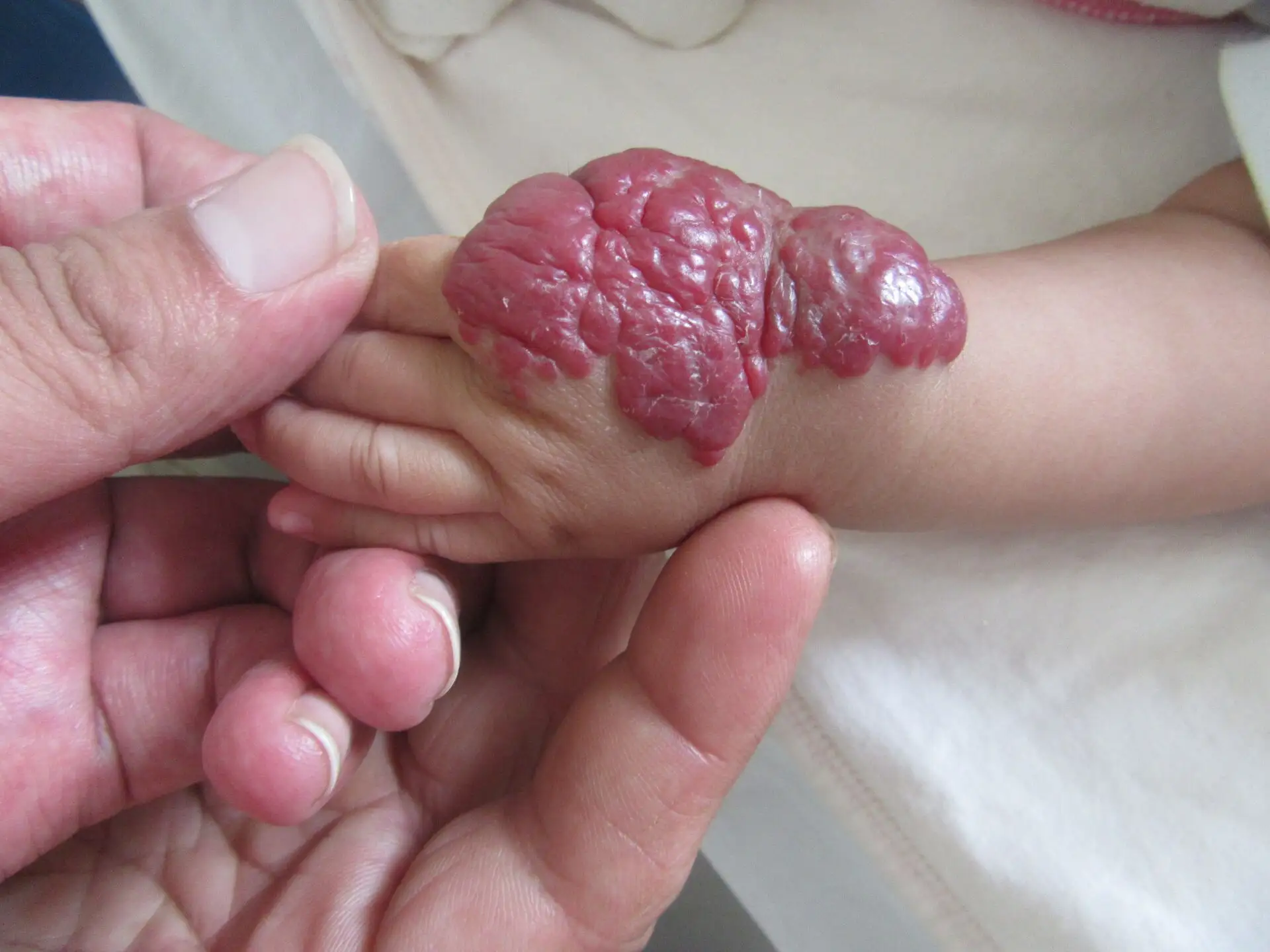 孩子脸上结出草莓,医生说是血管瘤,对孩子危害大吗?
