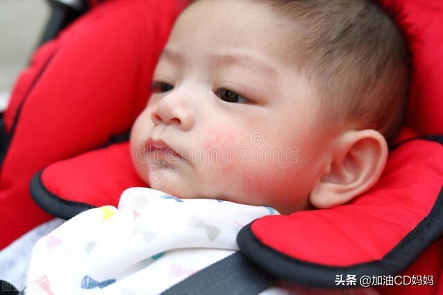 婴儿奶疹子怎么办（宝宝总是长疹子）