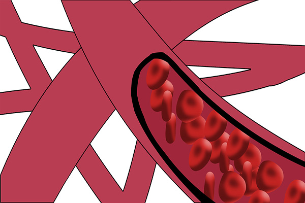 血管是怎么变堵、变硬的？喝醋、红酒能不能软化血管？