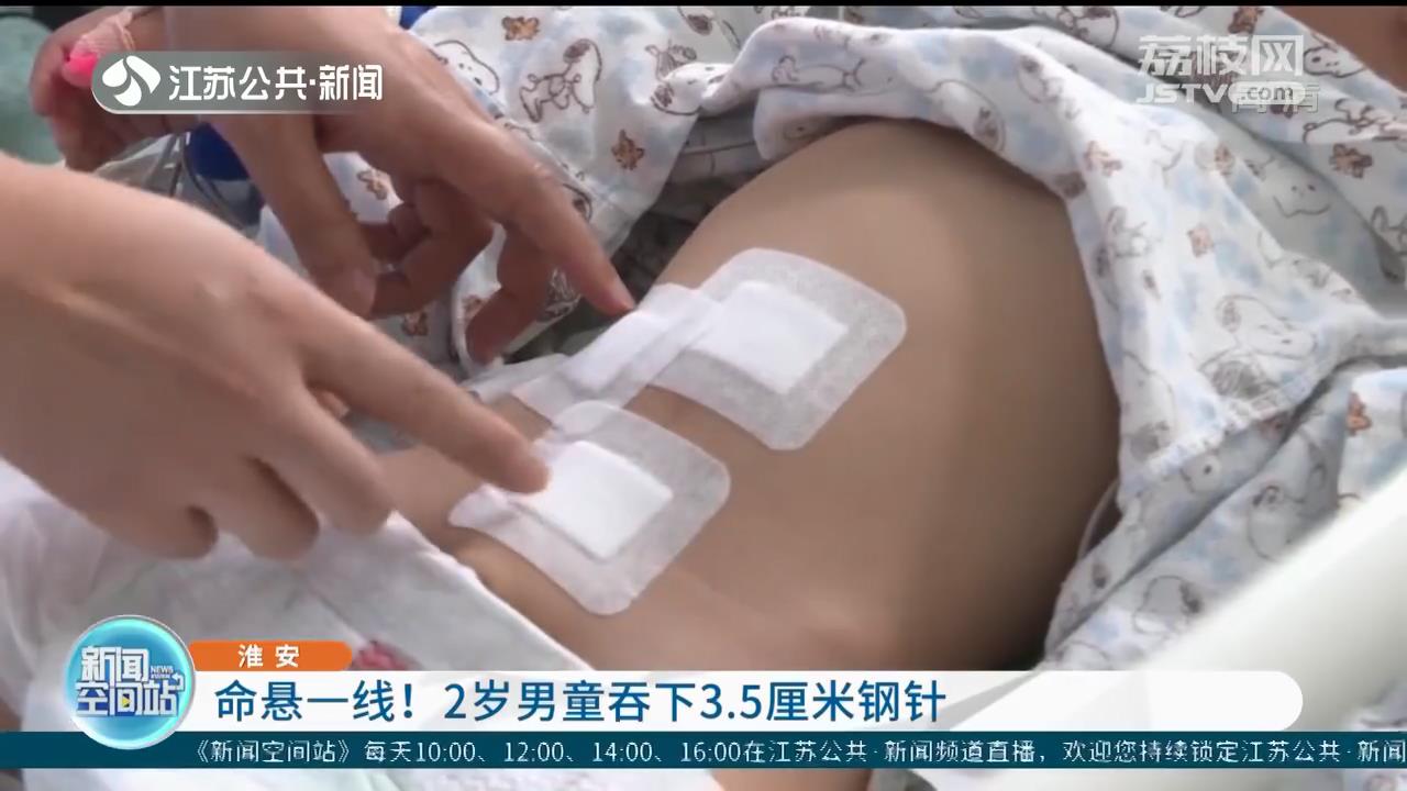 命悬一线！淮安2岁男童吞下3.5厘米钢针 一端扎在肠壁上