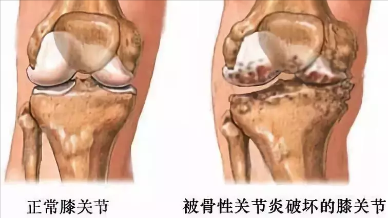 膝关节疼痛是怎么回事？不只是这3个病因，医生教你如何应对