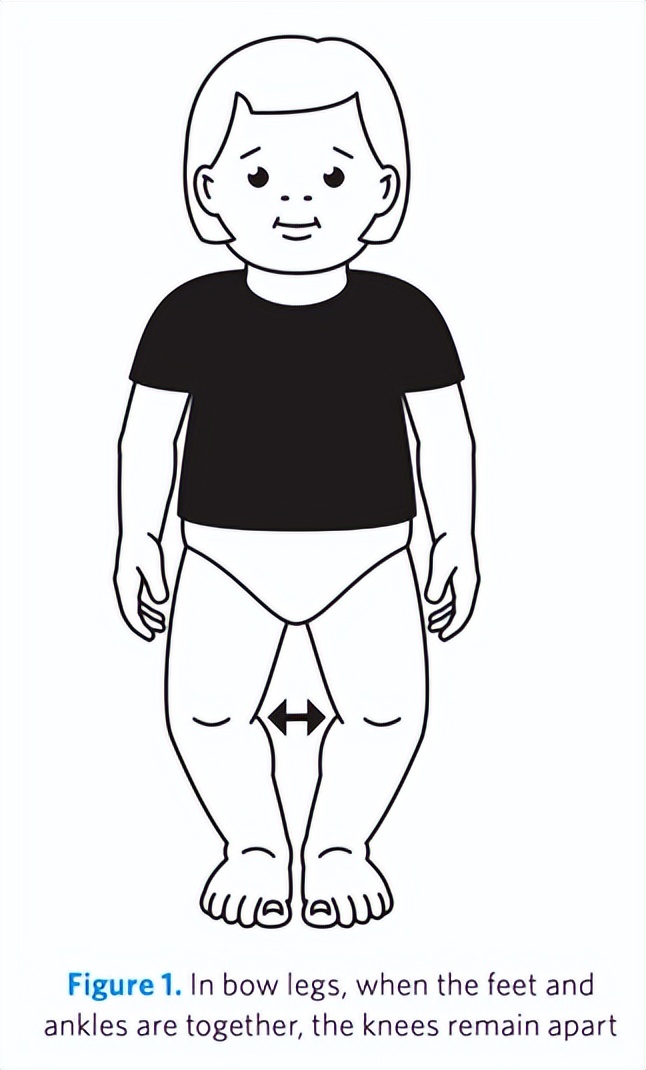 宝宝走路早,会罗圈腿吗?哪些情况要小心?