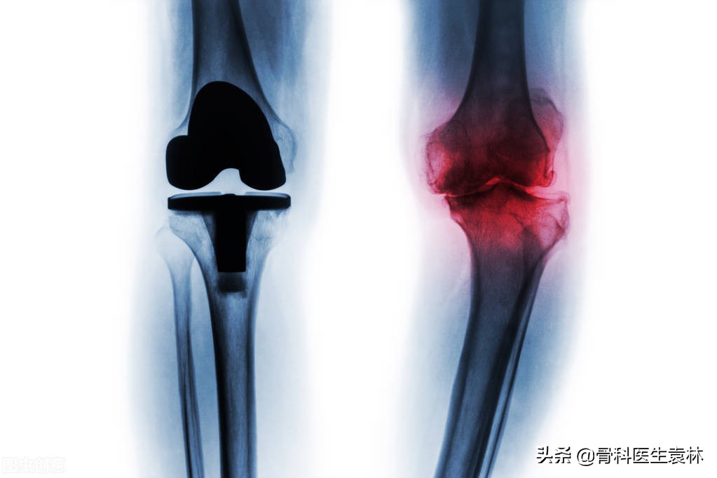 人工膝关节置换安全吗？人工膝关节能够用多久？