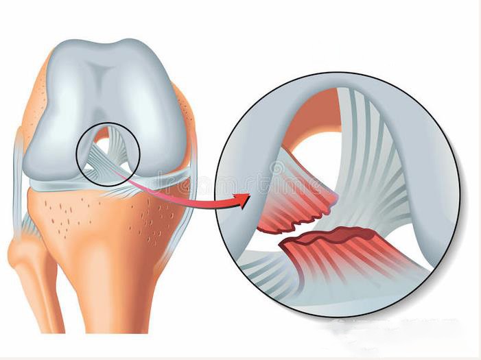 膝蓋“噼啪”一聲脆響，警惕前交叉韌帶受傷